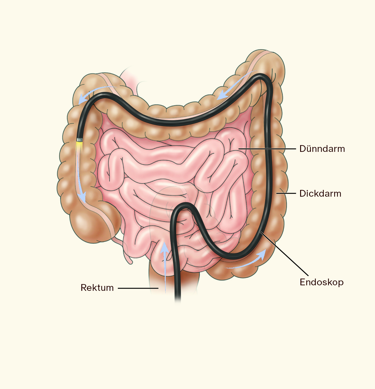 VorsorgeMann_Colonoscopy.png