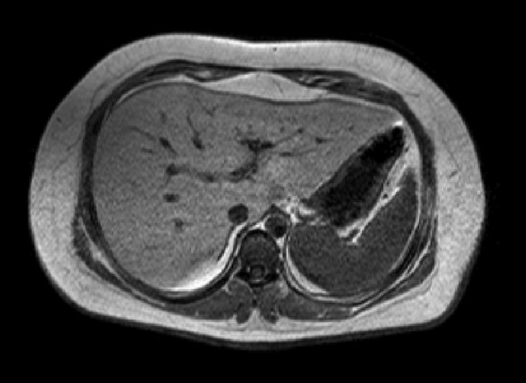 Fettleber MRI MRT