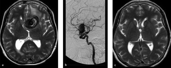 Aneurysma MRI