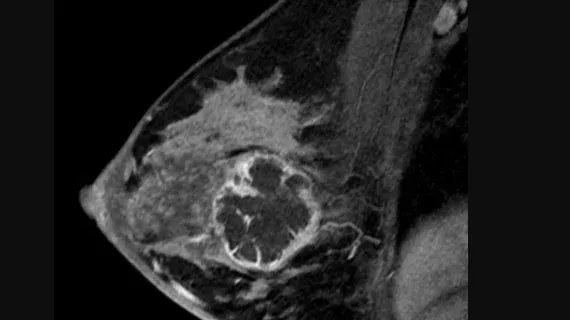 Brustkrebs im MRI