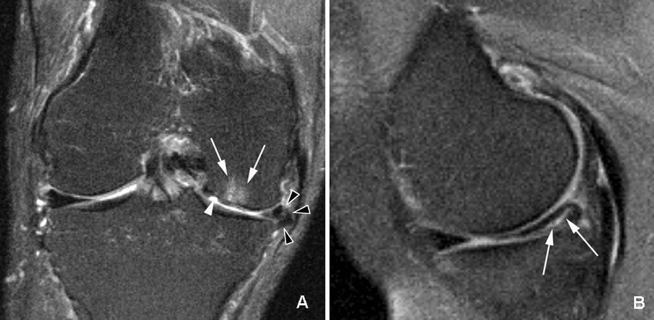 Erste Anzeichen Arthrose Knie MRI
